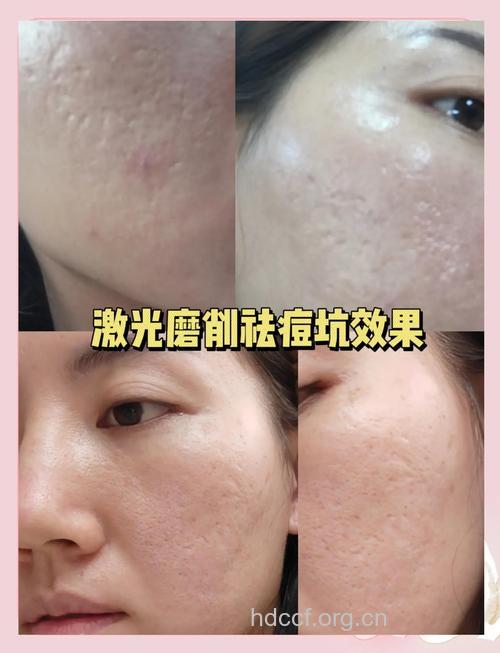 光子嫩肤祛痘会留疤吗 效果理想不留痕迹