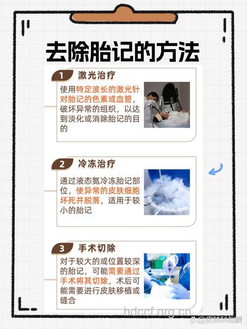 激光去胎记有哪些优势 年龄越小效果越好