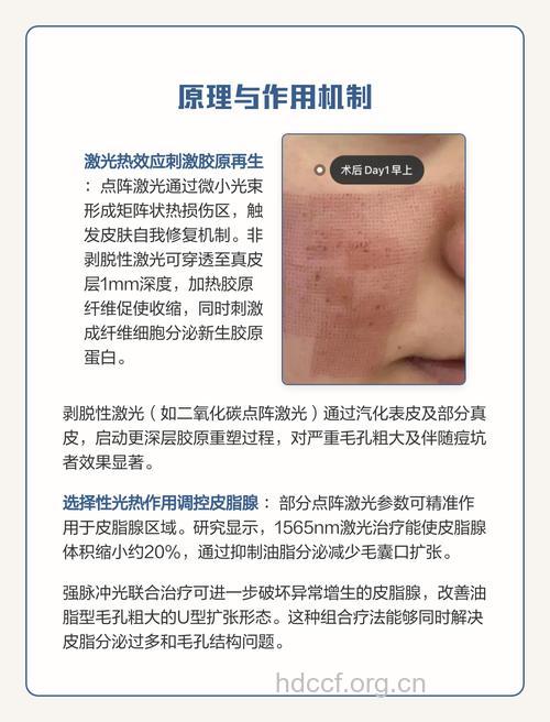 激光能收缩毛孔吗 怎么做效果能维持更久