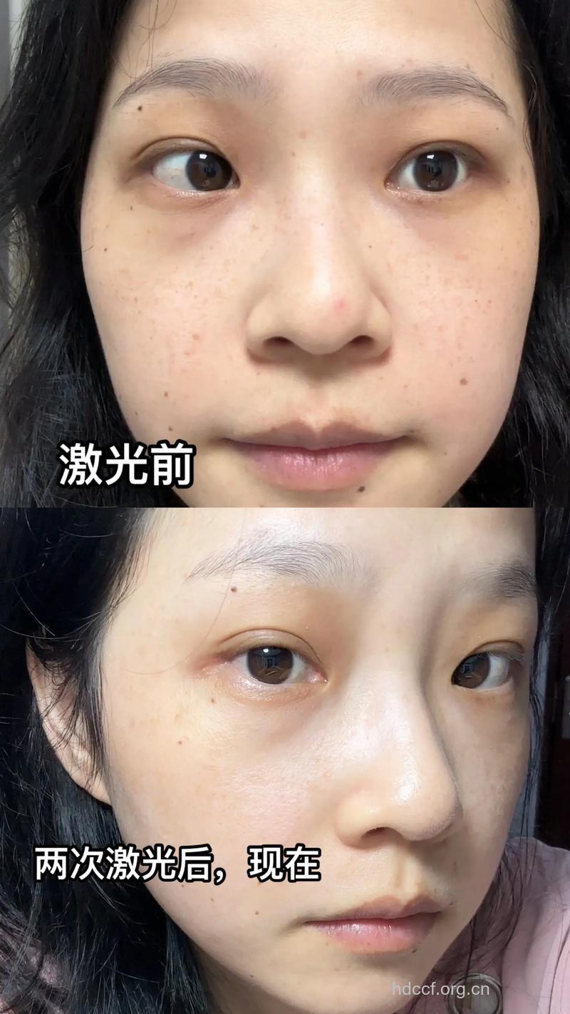 激光前后要做哪些准备