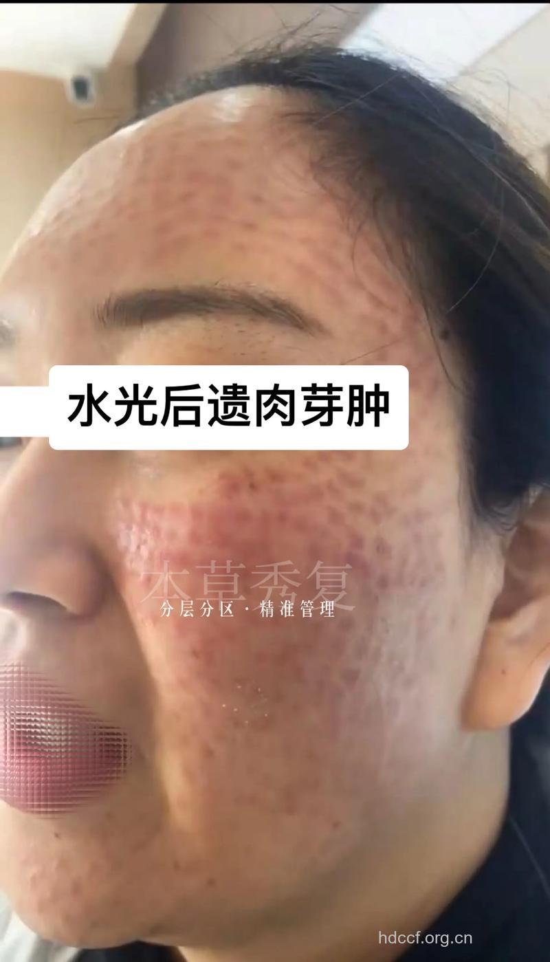 激光美容的后遗症有哪些危害