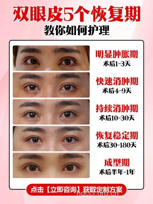 双眼皮手术后怎么尽快恢复