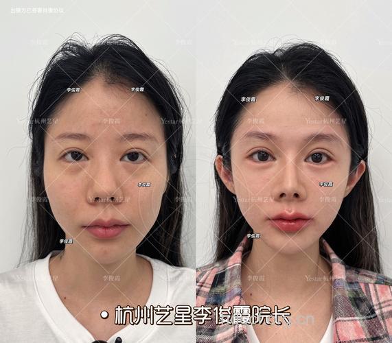 脸型手术前后有哪些注意
