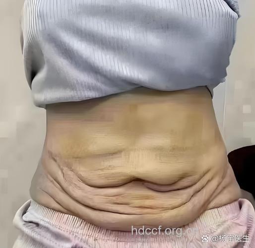 吸脂减肥会导致皮肤松弛吗