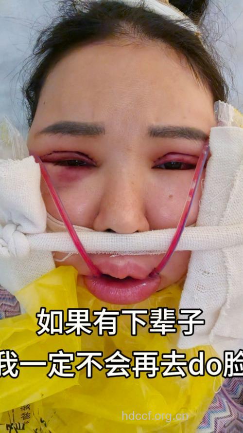 整形手术中最“急不得”的事