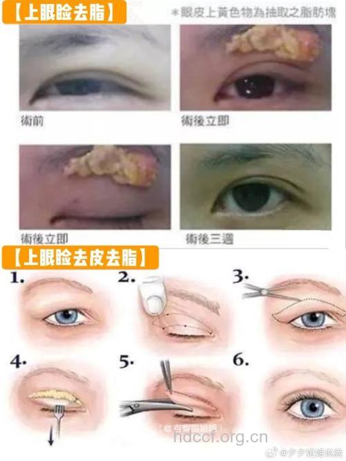 哪些人不能做上眼皮吸脂手术