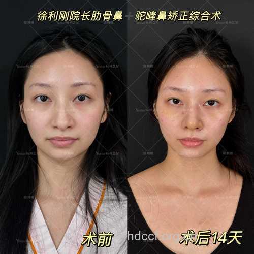 峰鼻矫正术后要注意些什么