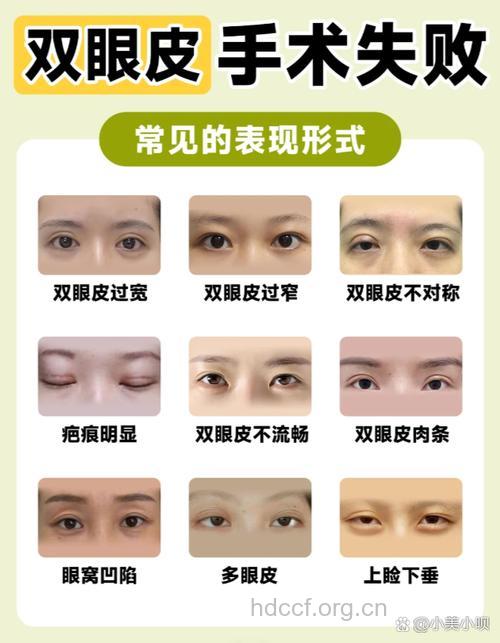 双眼皮术失败的临床表现及原因