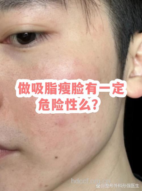 吸脂瘦脸有风险你造吗