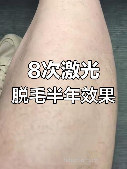 激光脱毛的效果