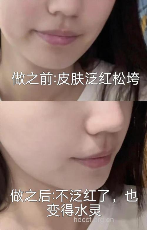 光子嫩肤美容比激光美容好？