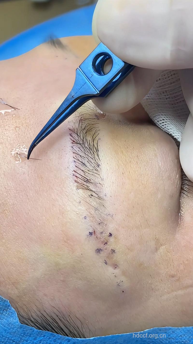 你知道眉毛种植的手术过程吗