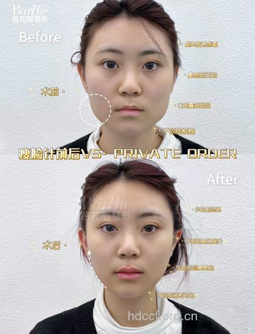 打瘦脸针前后有哪些注意