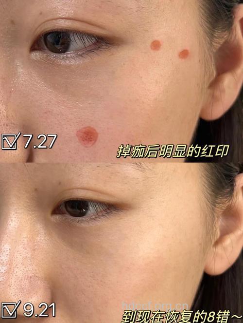 盘点8种痣 激光治疗超强效