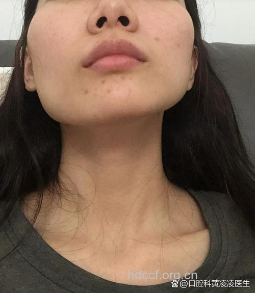 脸不对称要怎么办