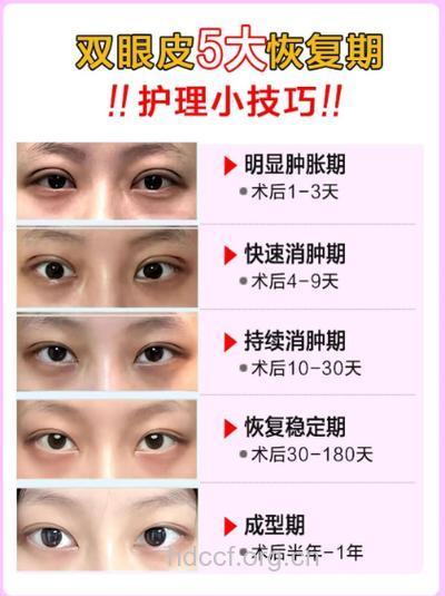 双眼皮以后多长时间可以戴眼镜呢？