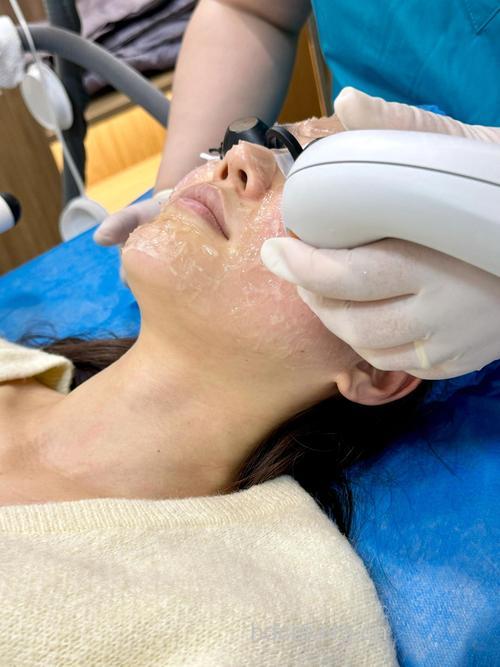 冬季光子嫩肤效果怎么样