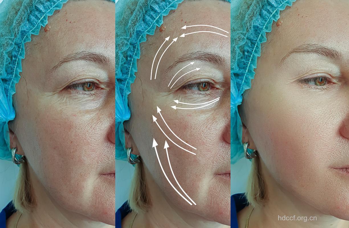 激光除皱效果怎么样