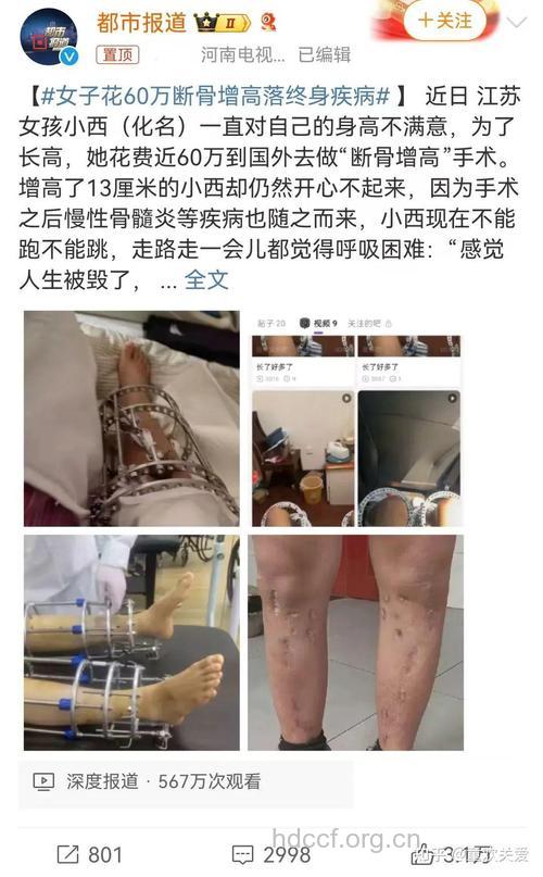 断骨增高为何变成残疾