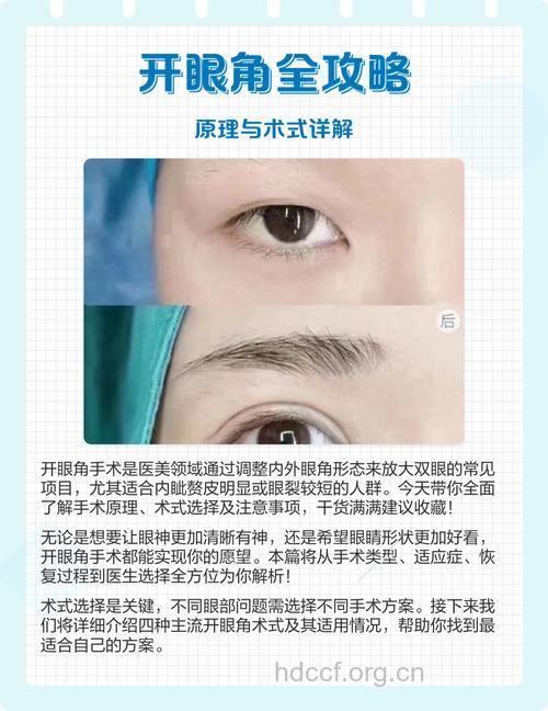 开眼角手术的原理和作用