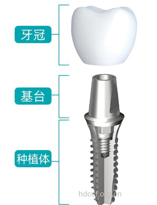 什么是纯钛牙齿植体