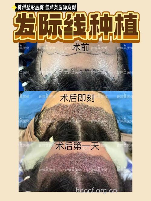 神奇的自体毛发种植