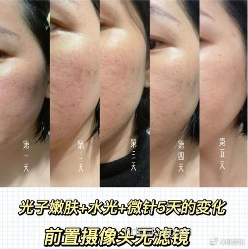 为什么光子嫩肤没效果?