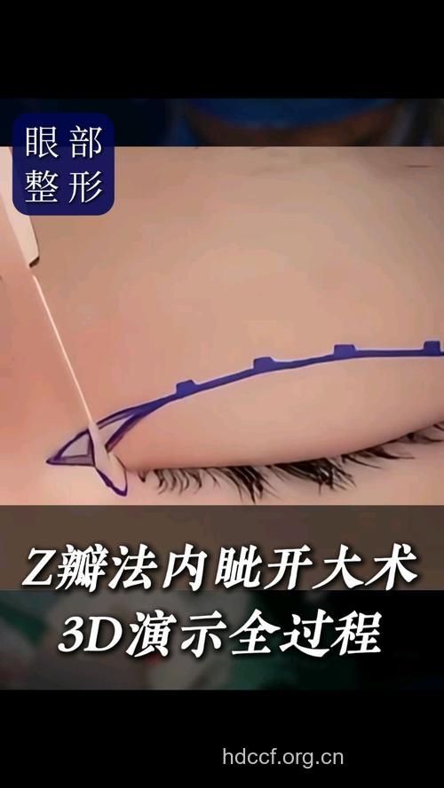 什么是开眼角手工术