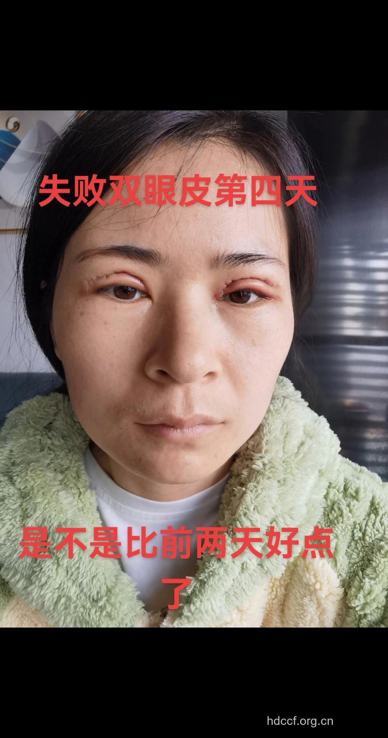 双眼皮手术失败可能的几个后果