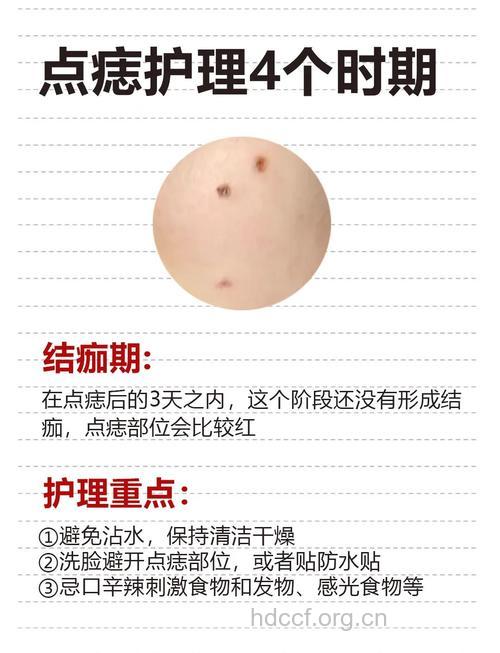 点痣时要注意哪些问题？