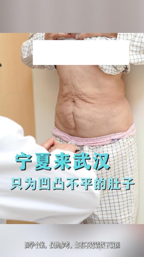 腹部整形抽脂哪些情况不能做？