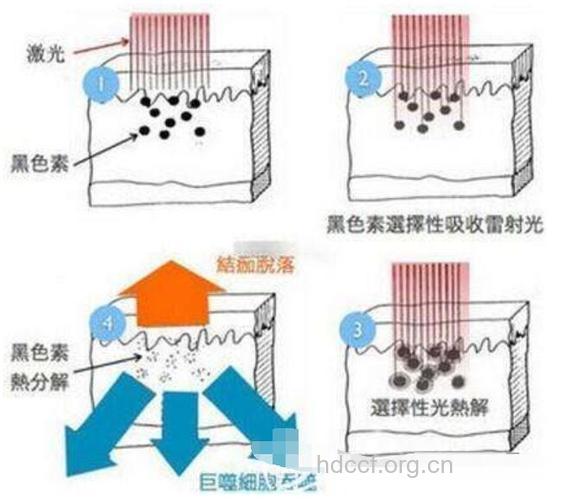 激光祛斑的原理