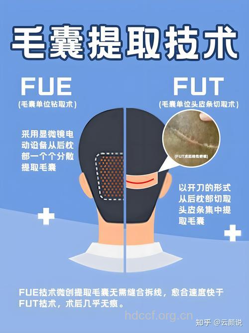 毛发种植技术?你不再为掉发烦恼