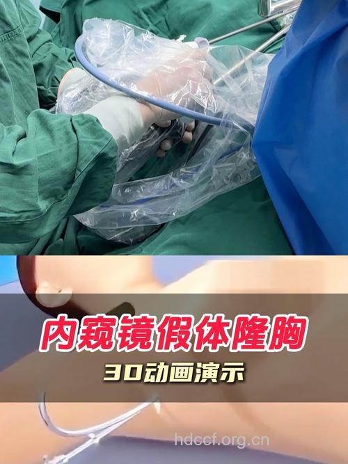 内窥镜隆胸让你的胸部超自然