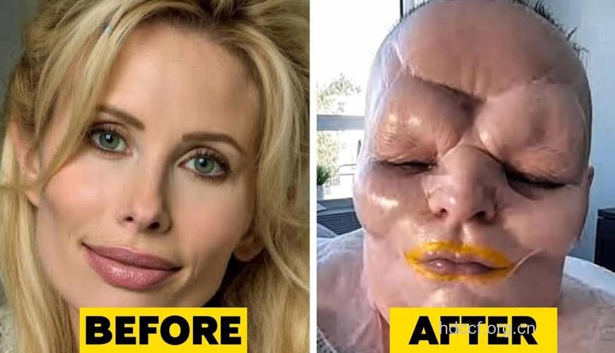 哪种整容手术最容易失败？