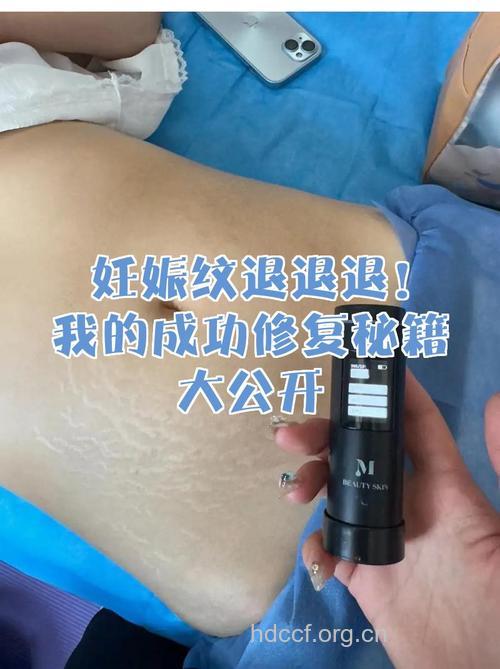 电波拉皮祛除妊娠纹方法