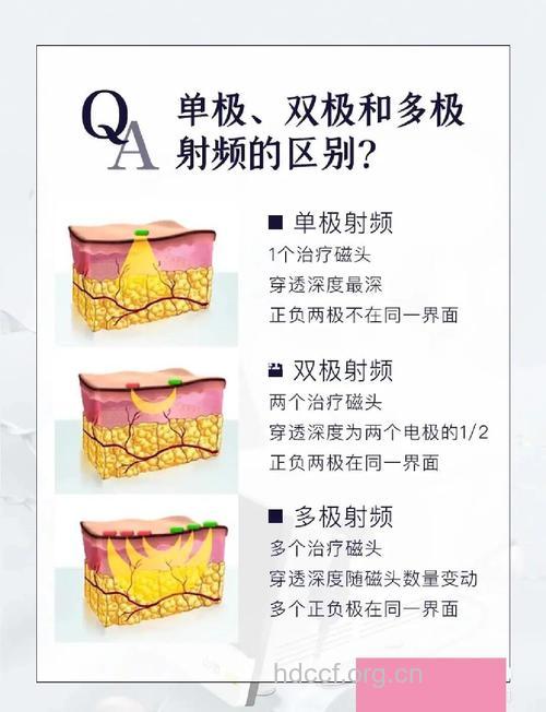 电波拉皮除皱有什么原理