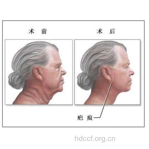 什么是拉皮除皱手术