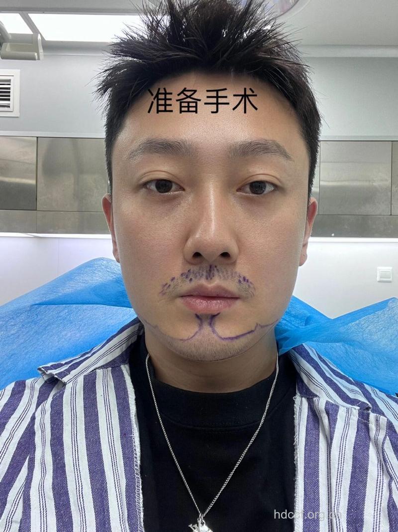 胡须种植是怎样进行的呢