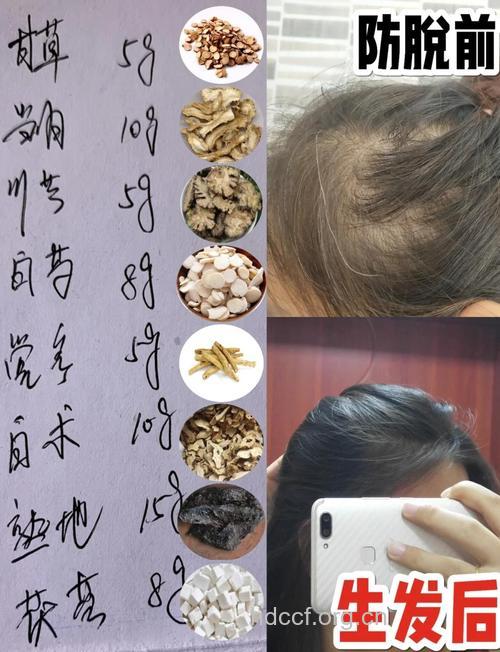 40岁女性脱发的六个偏方