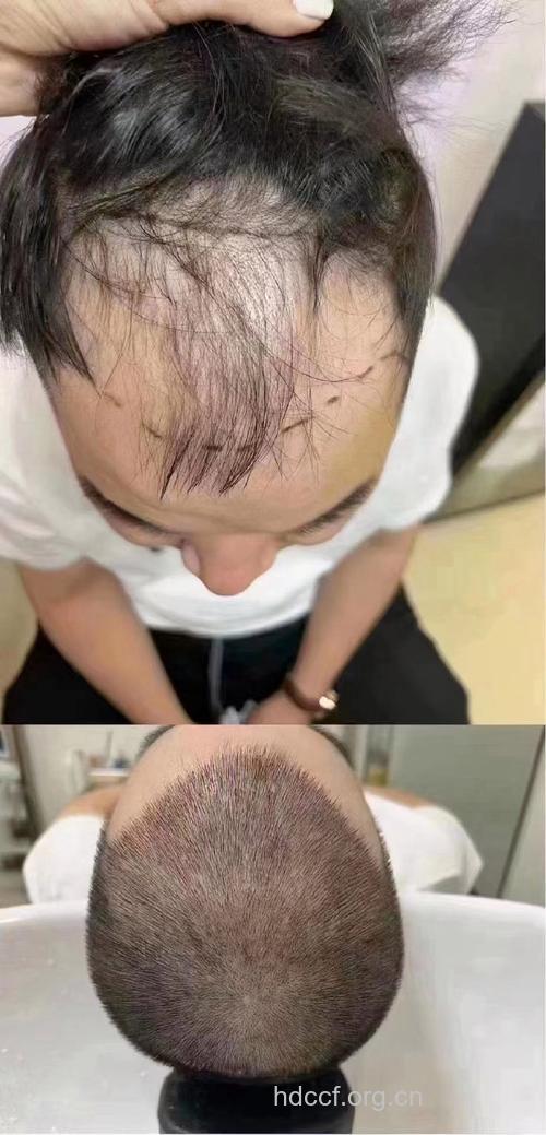 哪些人不适合做自体毛发移植