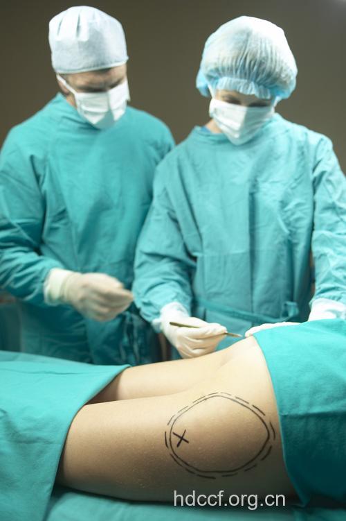 负压吸脂减肥手术