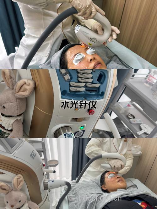 激光美容的应用有哪些