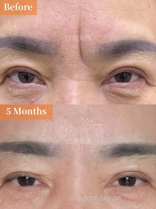 眉毛再造术有哪几种