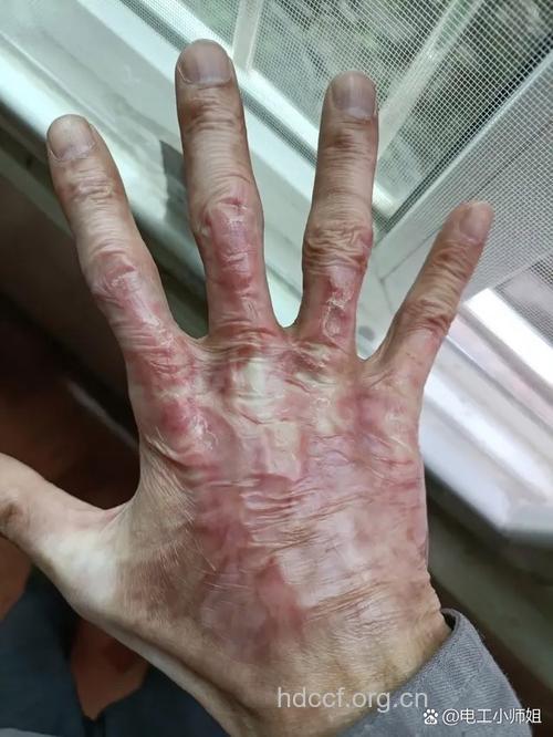 电灼褪色法