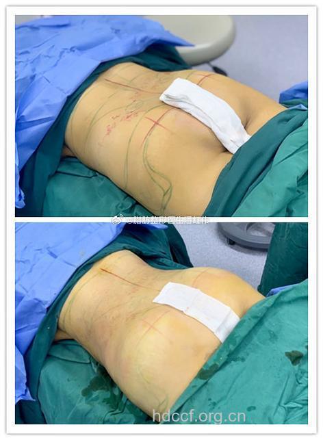 隆臀手术盛行英美