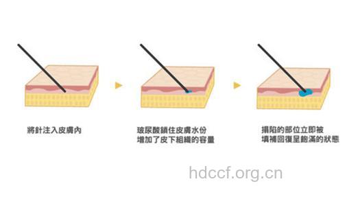 玻尿酸注射美容需要麻醉吗