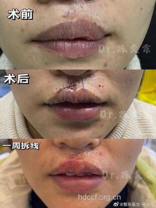 什么是唇红缘整复术？修复唇部意外裂伤