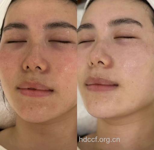 关于光子嫩肤的美容效果大公开