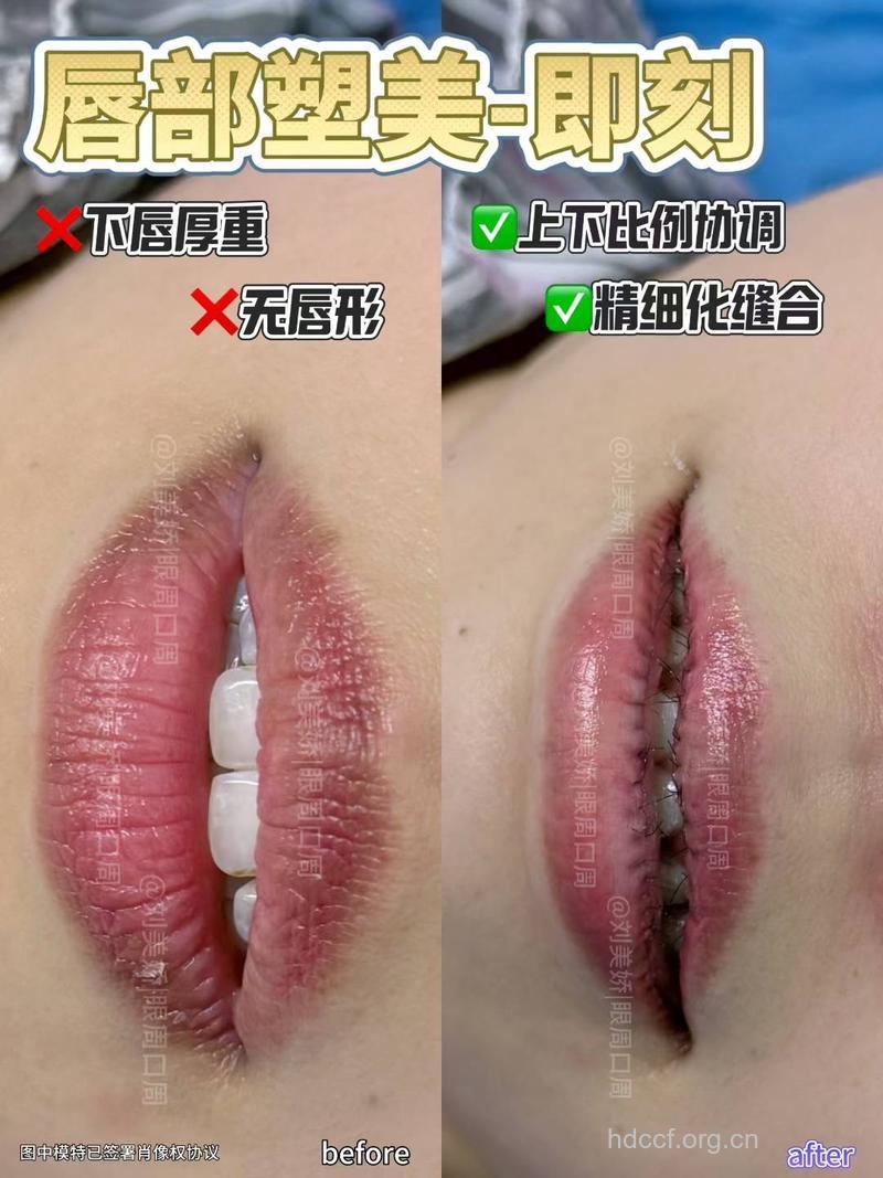 嘴唇改薄术是什么 嘴唇改薄过程揭秘
